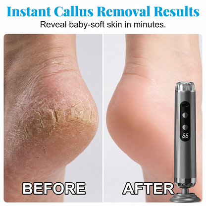 Spa-Ready Sale ✨ Aras™ 5-Speed Rechargeable Foot Smoother for Dry Feet 🌷